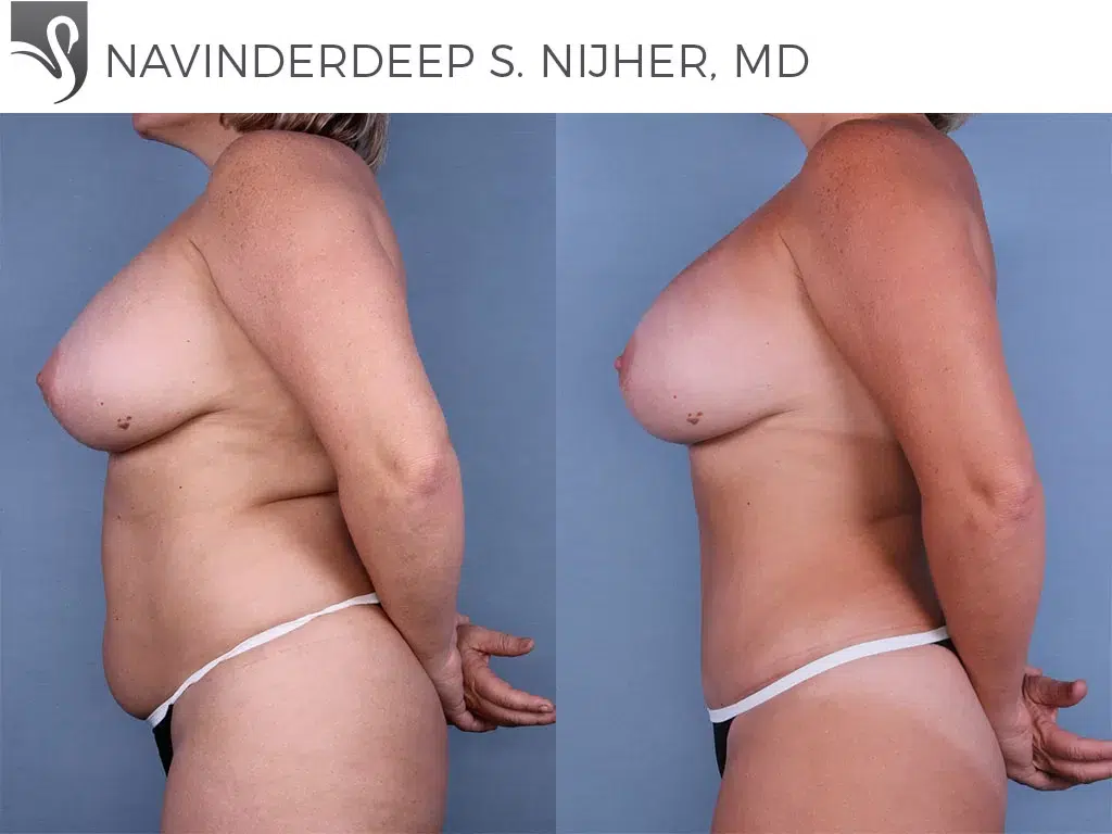 Before and After Image: Mommy Makeover Case #47923 - left-side
