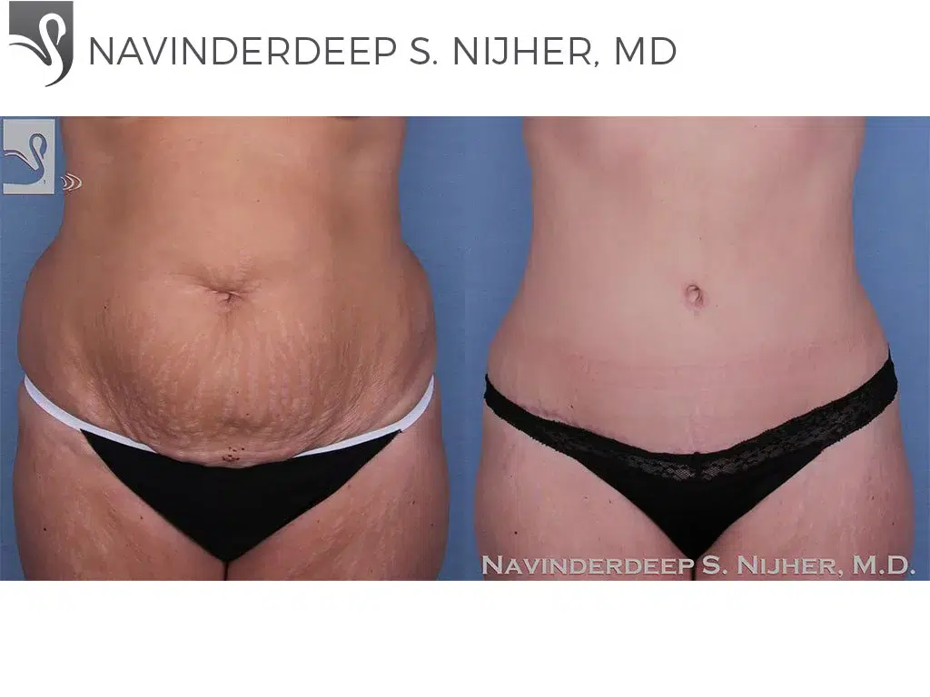Before and After Image: Abdominoplasty (Tummy Tuck) Case #47970 - front