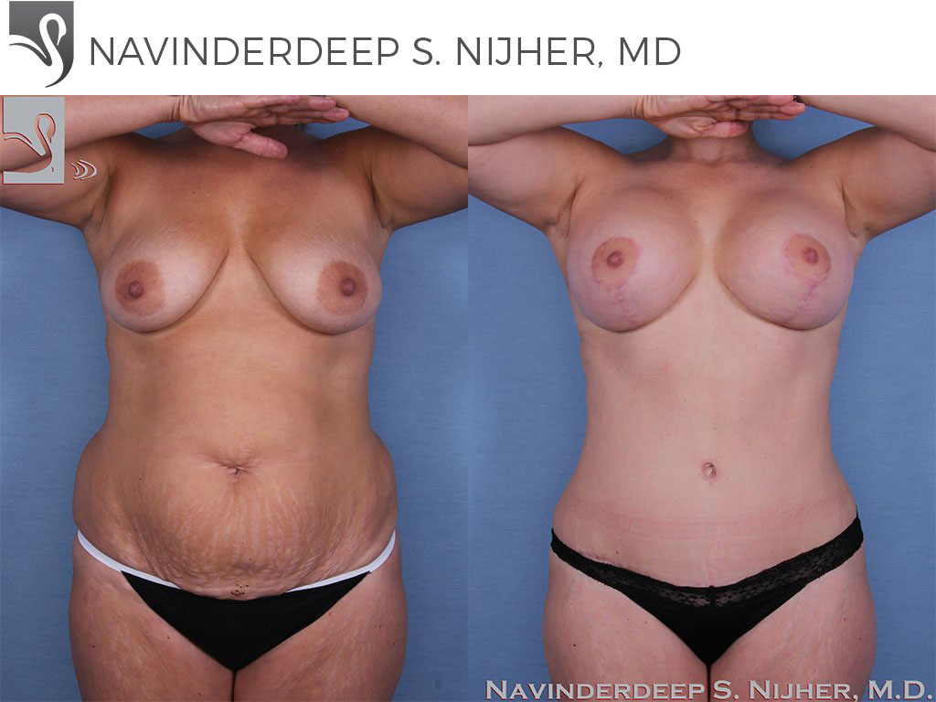Before and After Image: Mommy Makeover Case #47970 - front