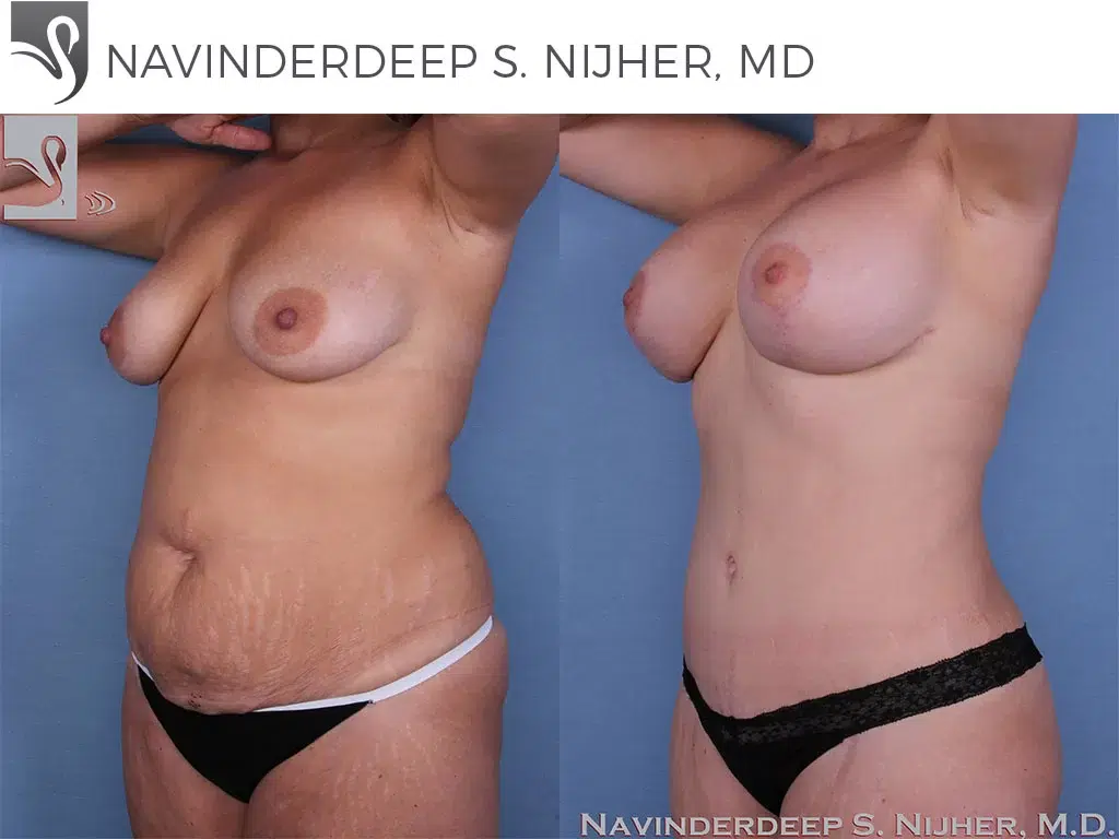 Before and After Image: Mommy Makeover Case #47970 - left-front-oblique