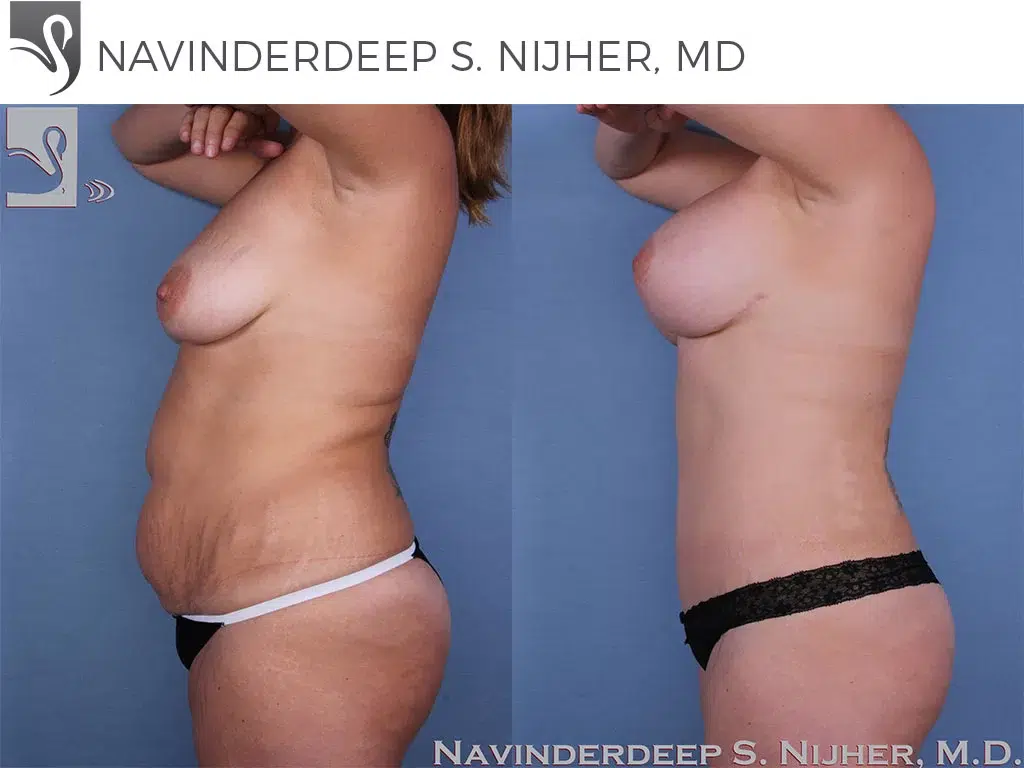 Before and After Image: Mommy Makeover Case #47970 - left-side