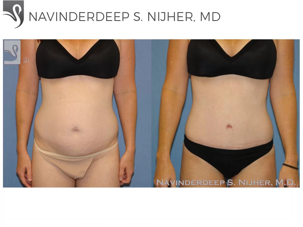 Before and After Image: Abdominoplasty (Tummy Tuck) Case #47944 - front