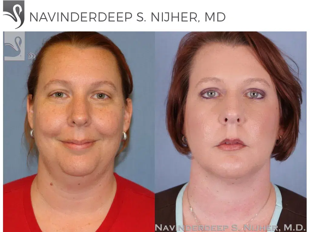 Before and After Image: Facial Implants Case #48230 - front