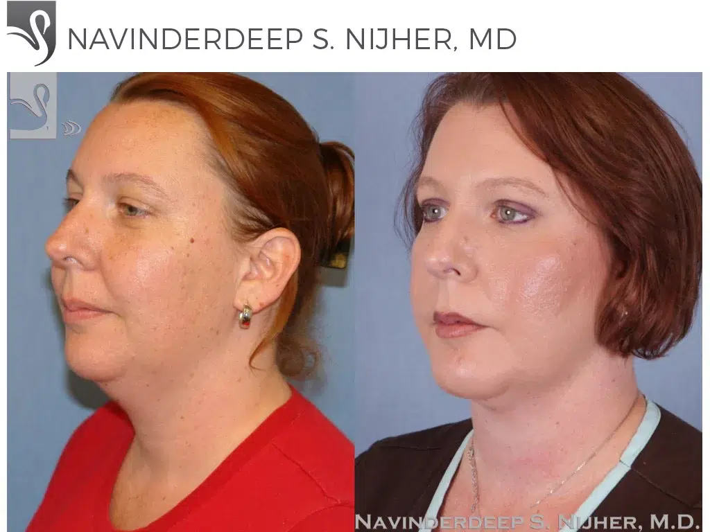 Before and After Image: Facial Implants Case #48230 - left-front-oblique