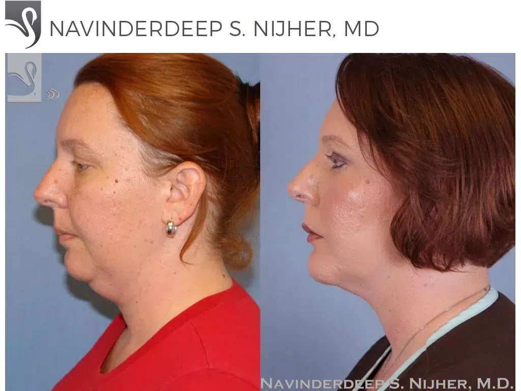 Before and After Image: Facial Implants Case #48230 - left-side