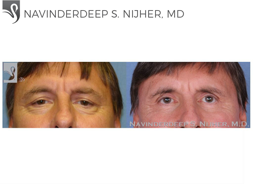 Before and After Image: Eyelid Surgery Case #48316 - front