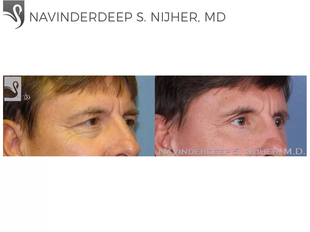 Before and After Image: Eyelid Surgery Case #48316 - right-front-oblique