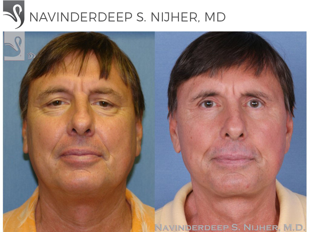 Before and After Image: Face Lift Case #48316 - front