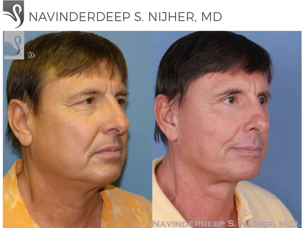 Before and After Image: Face Lift Case #48316 - right-front-oblique
