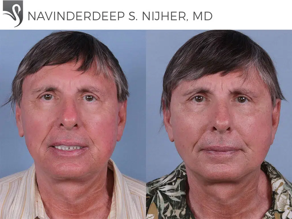 Before and After Image: Face Lift Case #48316 - front