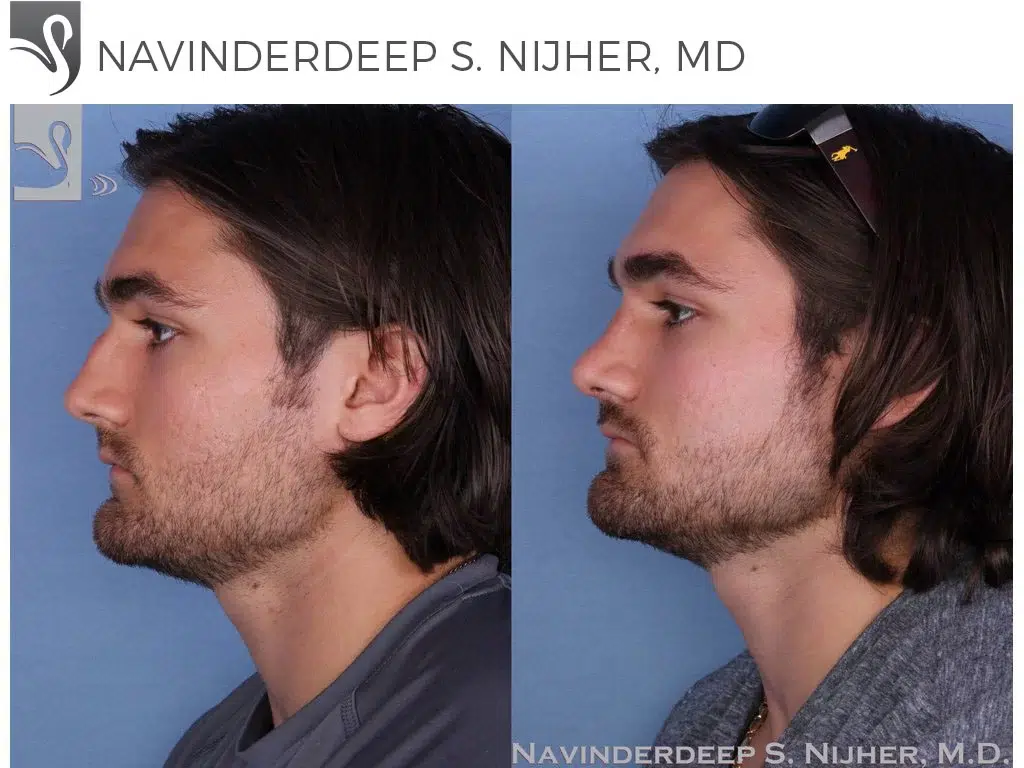 Before and After Image: Rhinoplasty Case #48428 - left-side