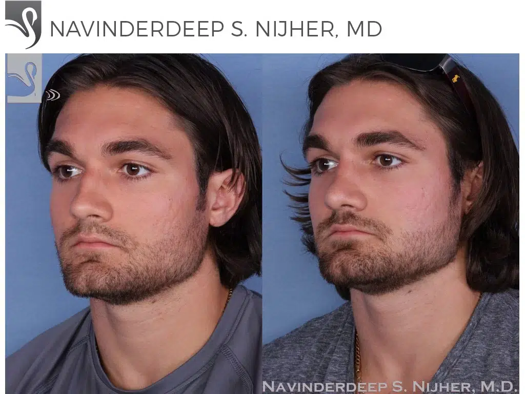 Before and After Image: Rhinoplasty Case #48428 - left-front-oblique