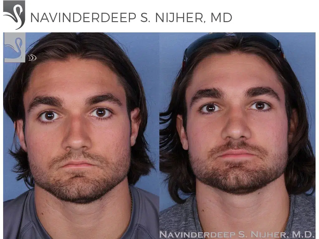 Before and After Image: Rhinoplasty Case #48428 - front