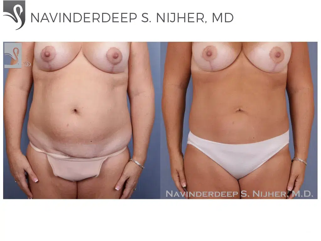 Before and After Image: Liposuction Case #48614 - front