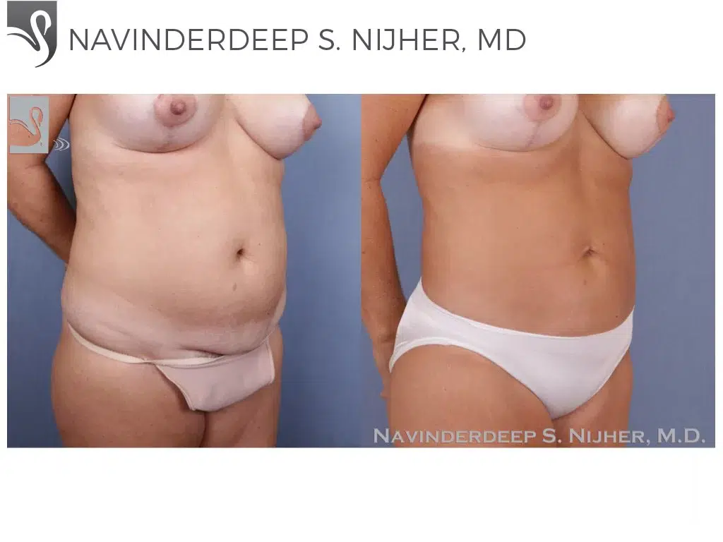 Before and After Image: Liposuction Case #48614 - right-front-oblique