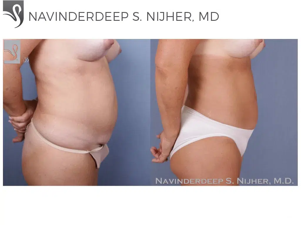 Before and After Image: Liposuction Case #48614 - right-side
