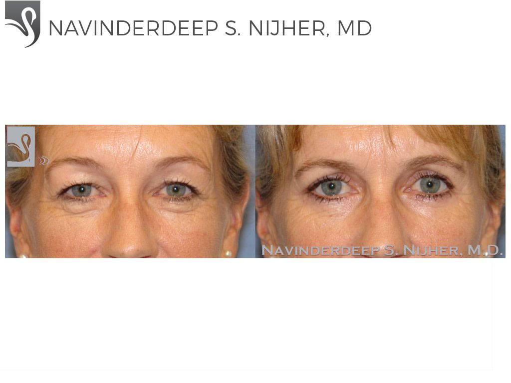 Before and After Image: Eyelid Surgery Case #48769 - front
