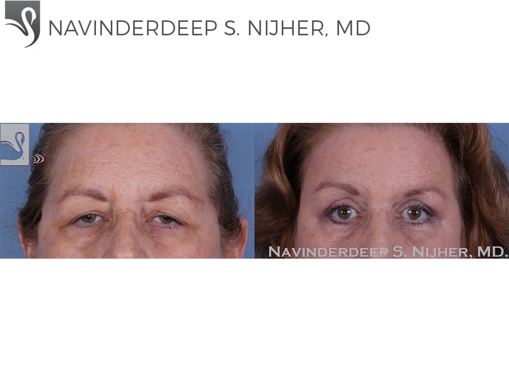 Before and After Image: Eyelid Surgery Case #49304 - front