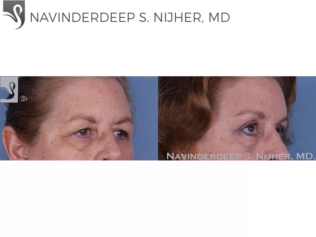 Before and After Image: Eyelid Surgery Case #49304 - right-front-oblique