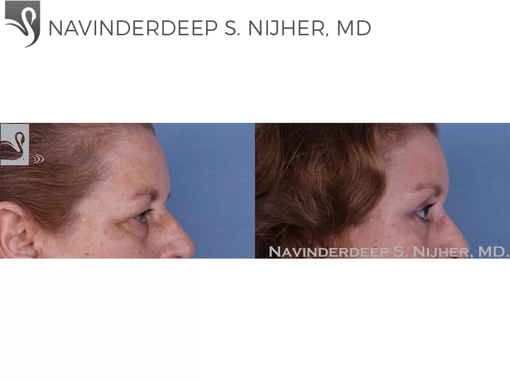 Before and After Image: Eyelid Surgery Case #49304 - right-side