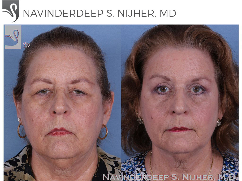Before and After Image: Brow Lift Case #49304 - front