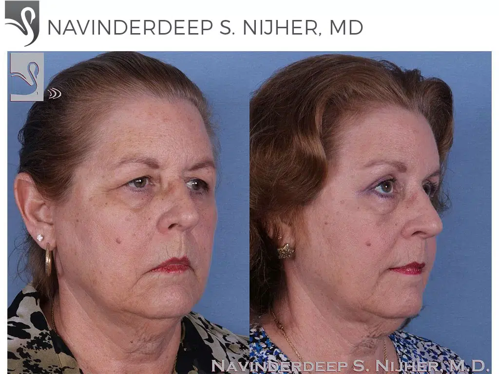 Before and After Image: Brow Lift Case #49304 - right-front-oblique