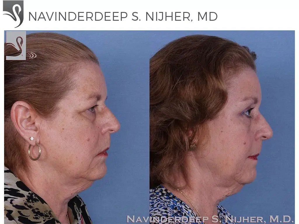 Before and After Image: Brow Lift Case #49304 - right-side