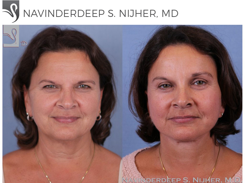 Before and After Image: Brow Lift Case #49794 - front