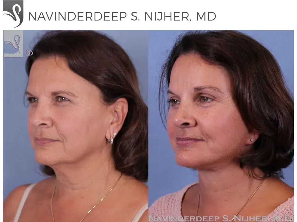 Before and After Image: Brow Lift Case #49794 - left-front-oblique