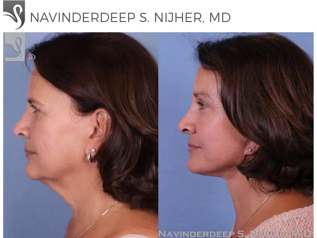 Before and After Image: Brow Lift Case #49794 - left-side