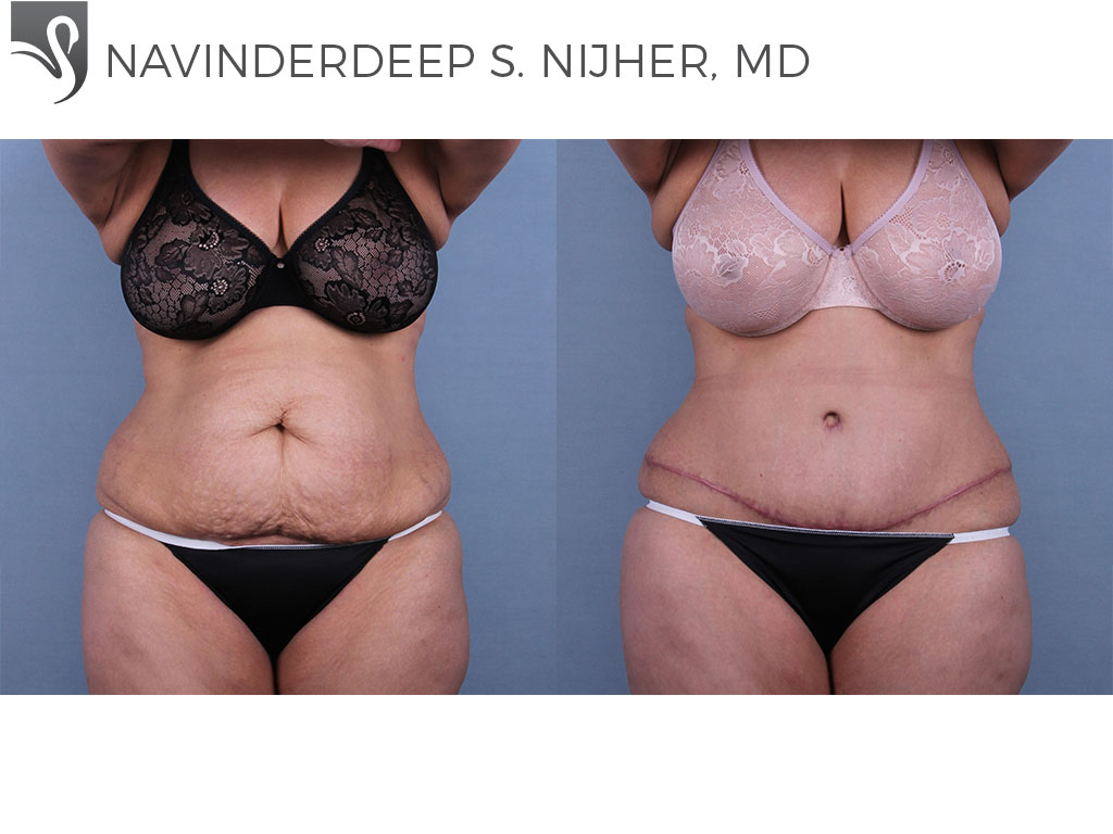 Before and After Image: Abdominoplasty (Tummy Tuck) Case #49845 - front