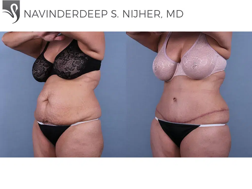 Before and After Image: Abdominoplasty (Tummy Tuck) Case #49845 - left-front-oblique