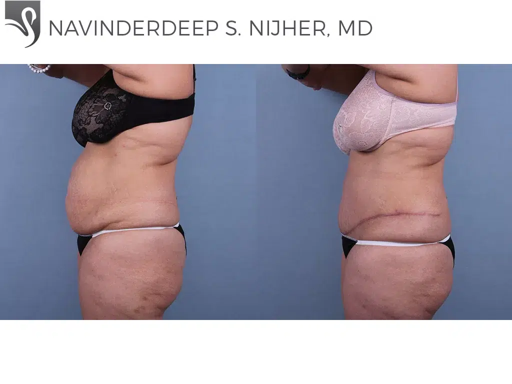 Before and After Image: Abdominoplasty (Tummy Tuck) Case #49845 - left-side