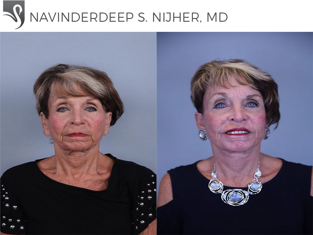 Before and After Image: Face Lift Case #49907 - front