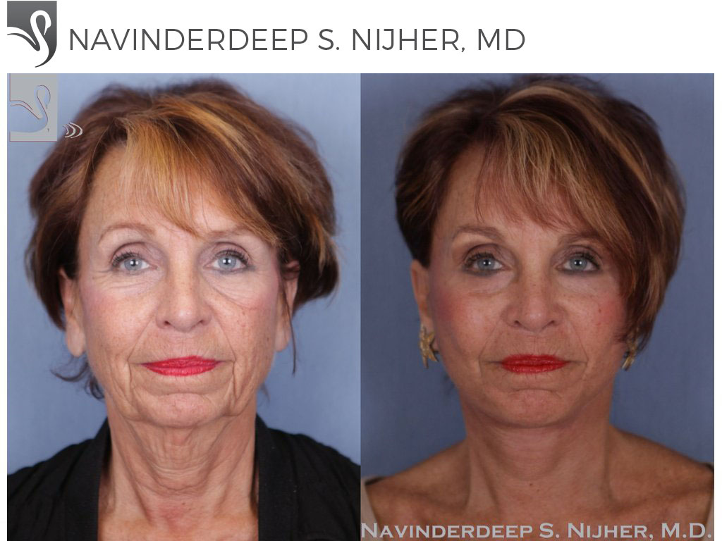 Before and After Image: Face Lift Case #49907 - front