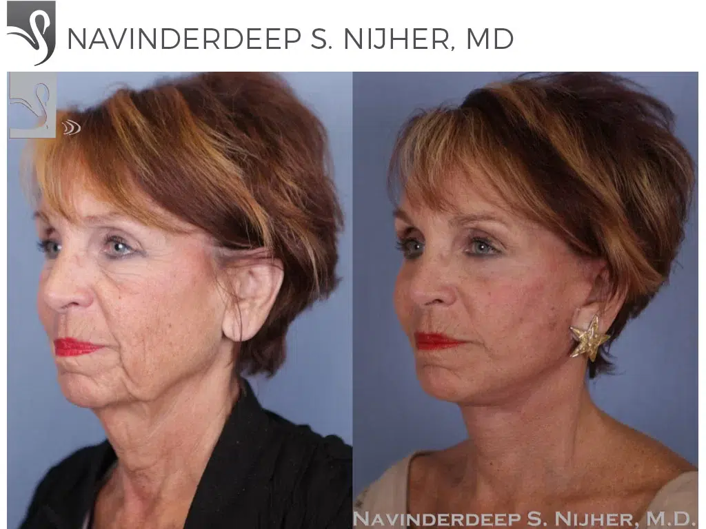 Before and After Image: Face Lift Case #49907 - left-front-oblique
