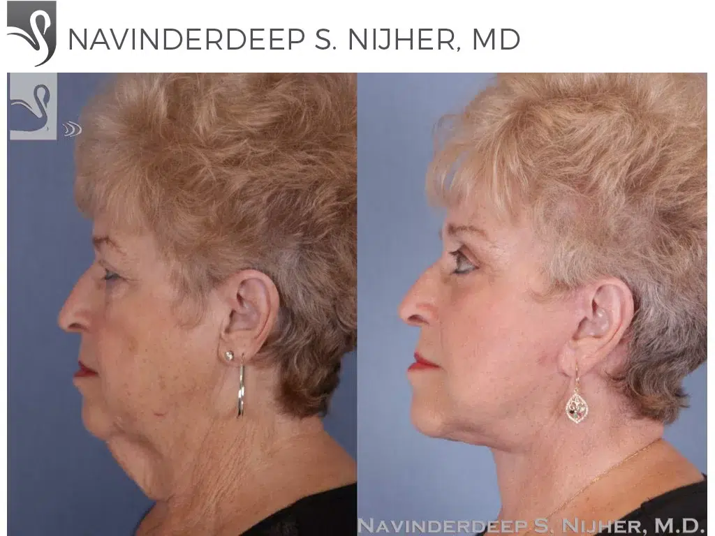 Before and After Image: Brow Lift Case #50252 - left-side