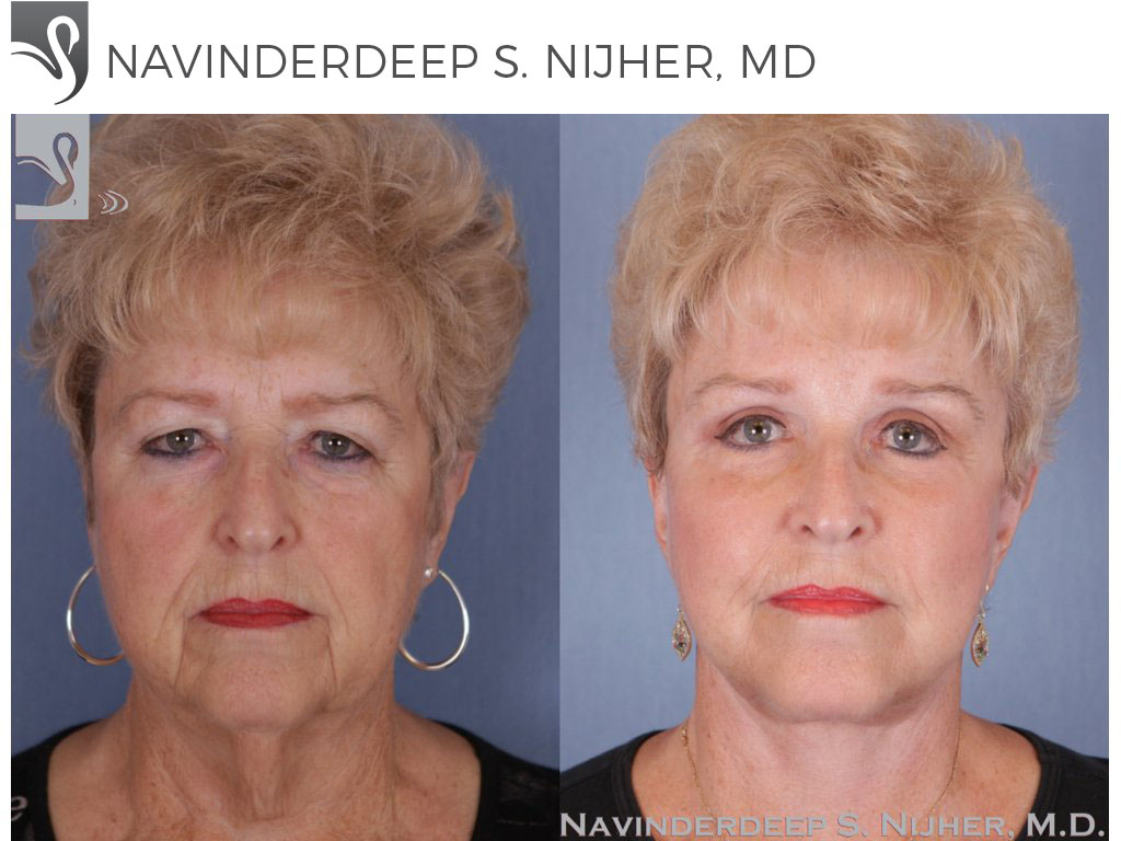Before and After Image: Face Lift Case #50252 - front