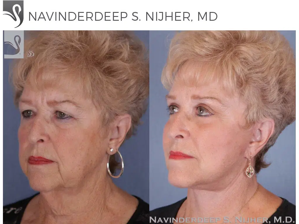 Before and After Image: Face Lift Case #50252 - left-front-oblique