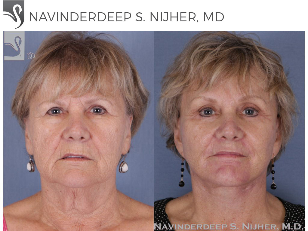 Before and After Image: Brow Lift Case #50464 - front