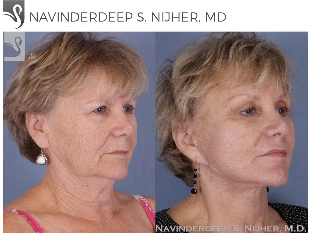 Before and After Image: Brow Lift Case #50464 - right-front-oblique