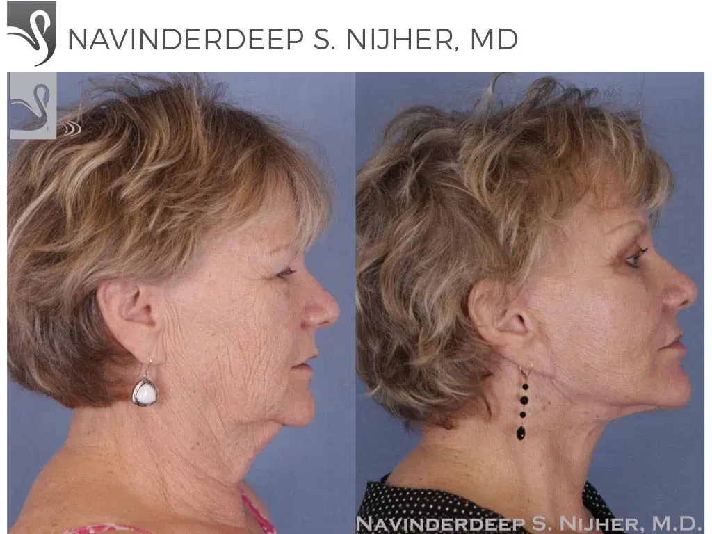 Before and After Image: Brow Lift Case #50464 - right-side