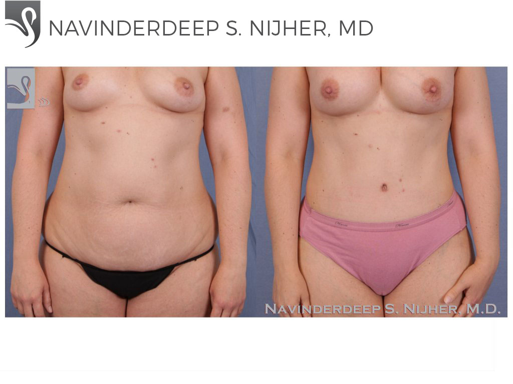 Before and After Image: Abdominoplasty (Tummy Tuck) Case #50631 - front