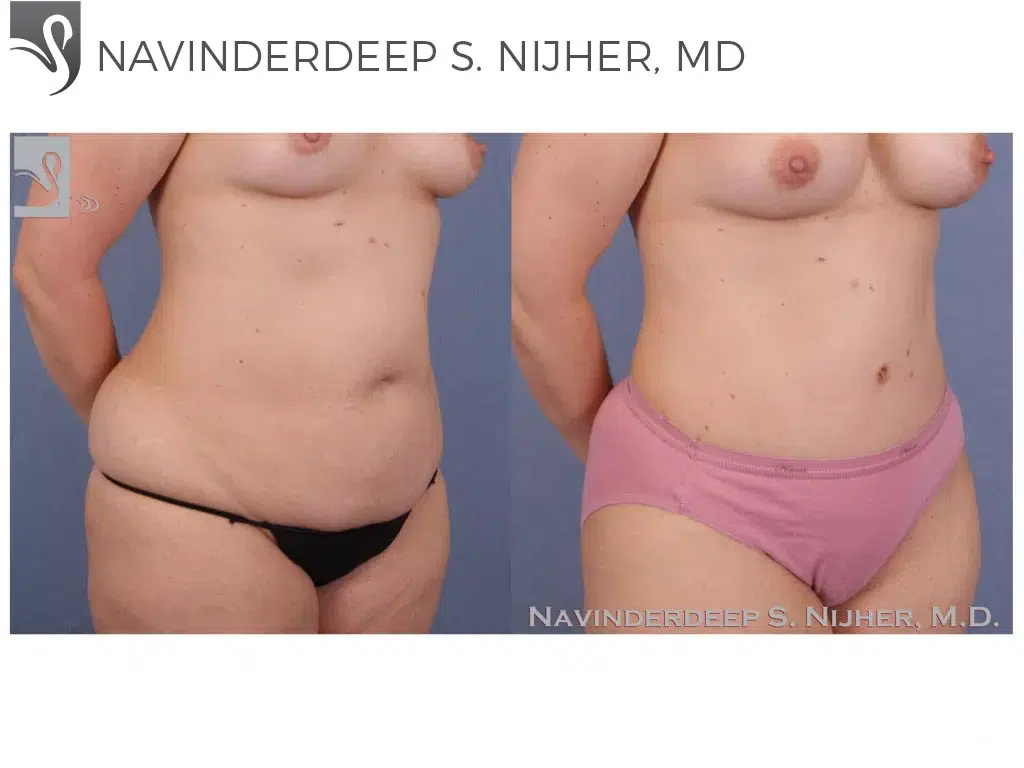 Before and After Image: Abdominoplasty (Tummy Tuck) Case #50631 - right-front-oblique
