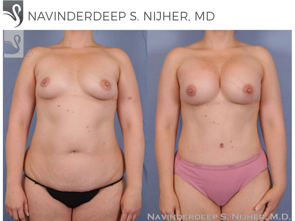 Before and After Image: Mommy Makeover Case #50631 - front