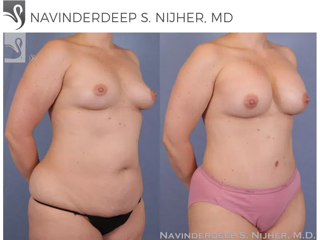 Before and After Image: Mommy Makeover Case #50631 - right-front-oblique