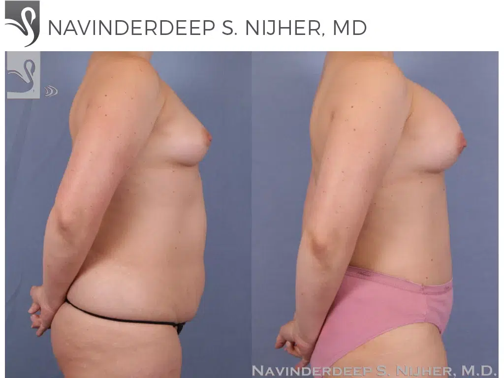 Before and After Image: Mommy Makeover Case #50631 - right-side