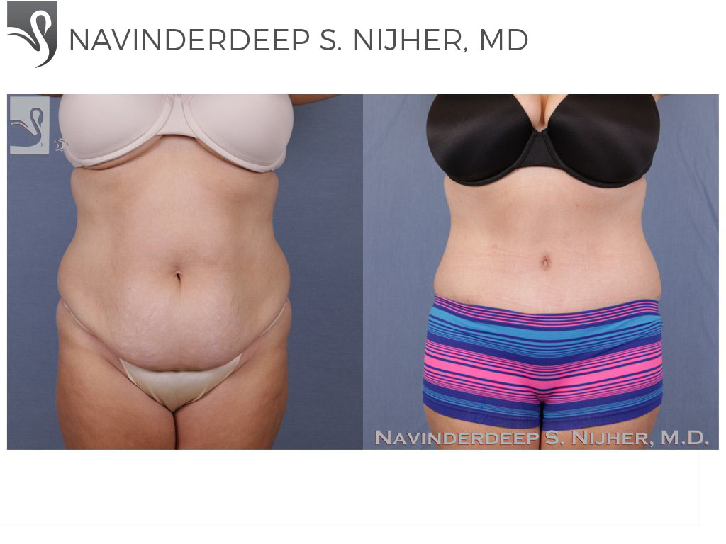 Before and After Image: Abdominoplasty (Tummy Tuck) Case #51130 - front