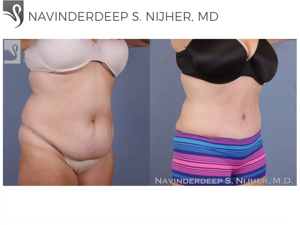 Before and After Image: Abdominoplasty (Tummy Tuck) Case #51130 - right-front-oblique