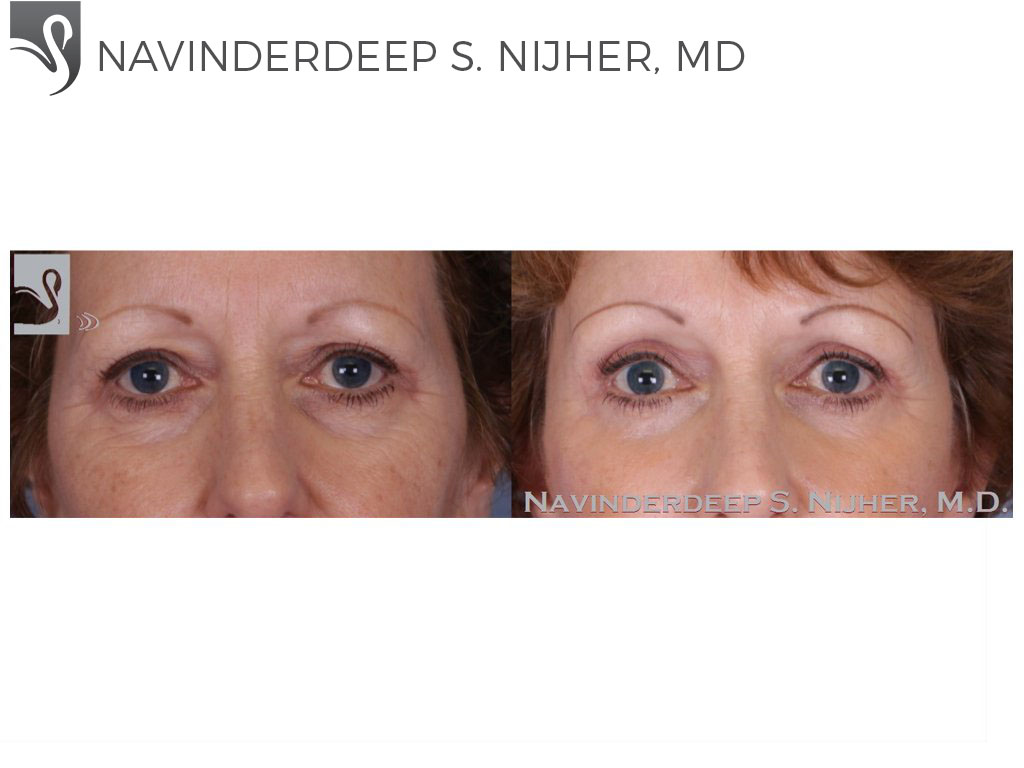 Before and After Image: Eyelid Surgery Case #51160 - front